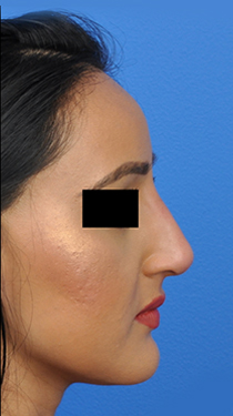 Non-Surgical Rhinoplasty Before and After