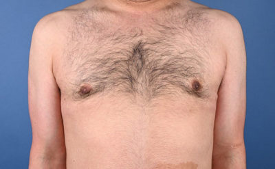 Male Gynecomastia Before and After