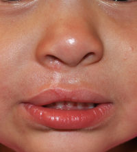 Cleft Lip