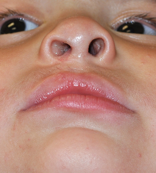 Cleft Lip