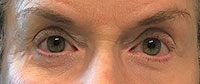 Blepharoplasty