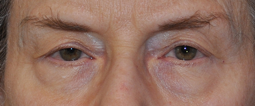 Brow Lift Before and After