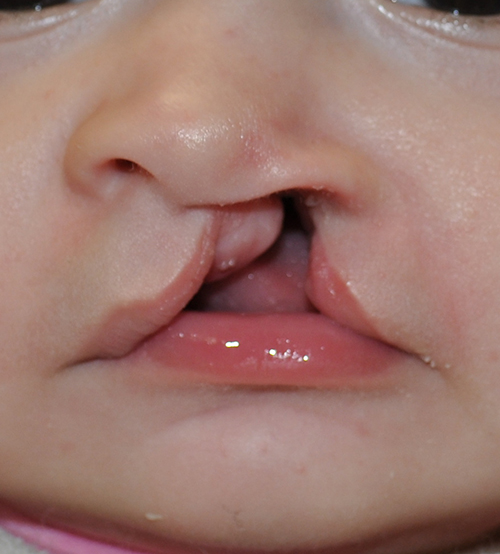 Cleft Lip