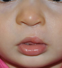 Cleft Lip and Palate Before and After