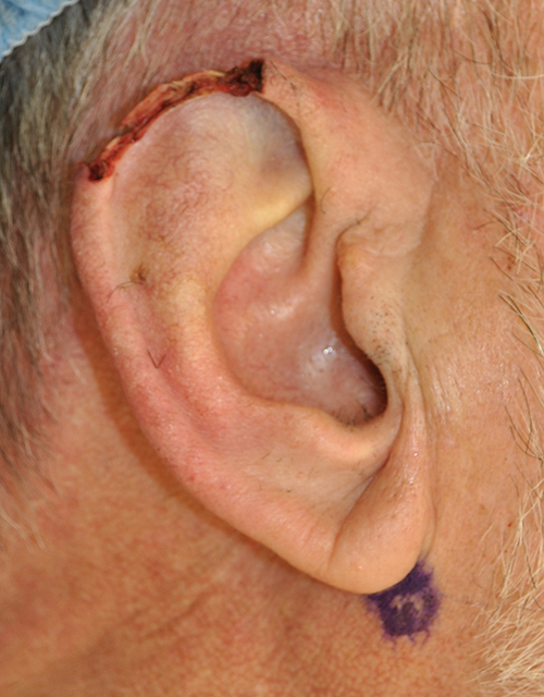 Ear Reconstruction Before and After