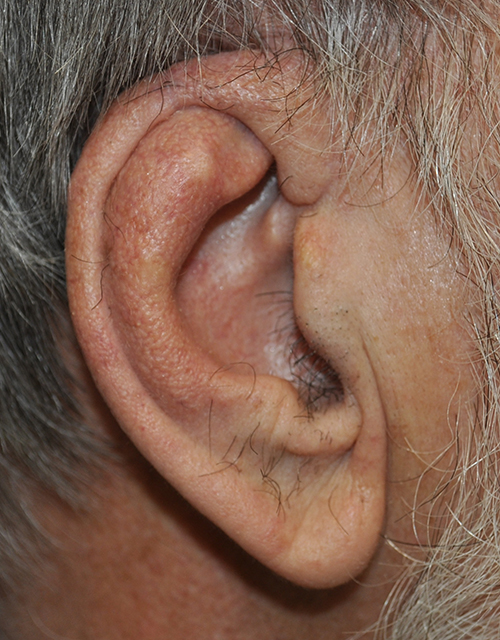 Ear Reconstruction Before and After