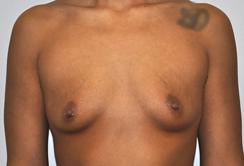 Breast Augmentation