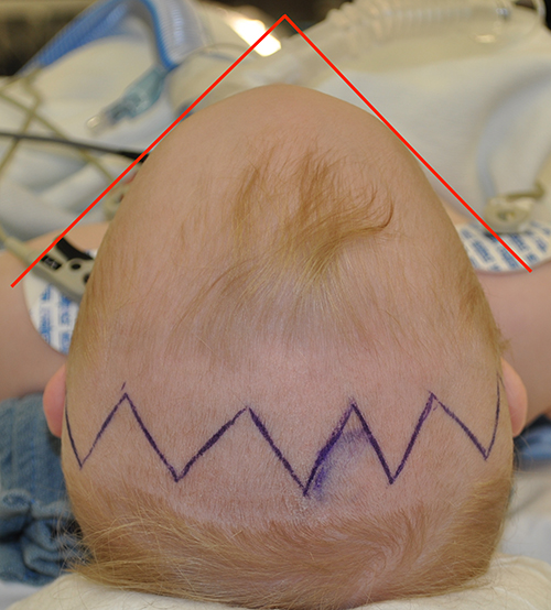 Craniosynostosis Repair Before and After