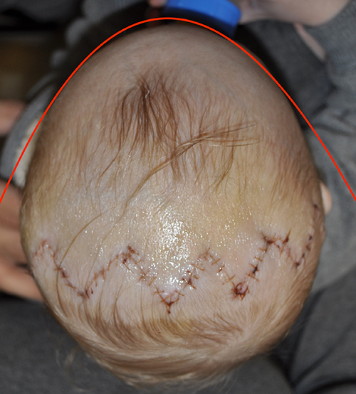 Craniosynostosis Repair Before and After