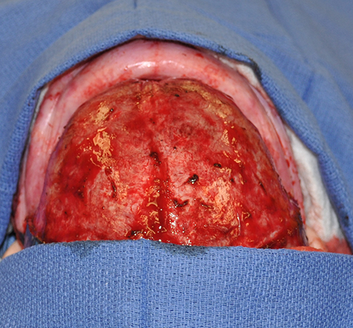 Craniosynostosis