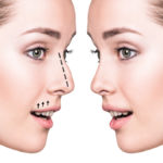 How to choose the right surgeon for rhinoplasty