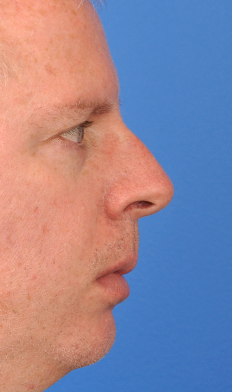 Male Rhinoplasty