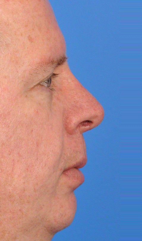 Male Rhinoplasty