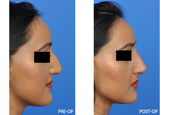 Pre-Op and Post-Op Photos