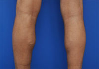 Calf Augmentation