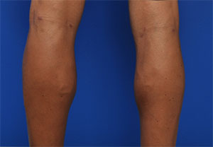 Male Calf Implants Before and After