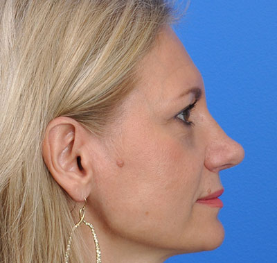 Rhinoplasty