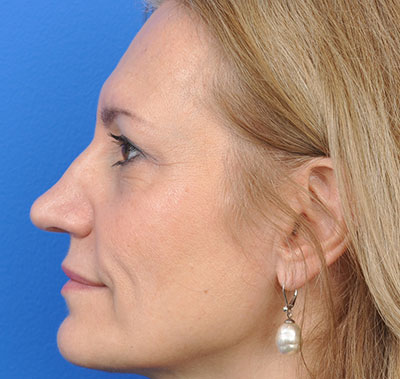 Rhinoplasty