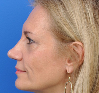 Rhinoplasty