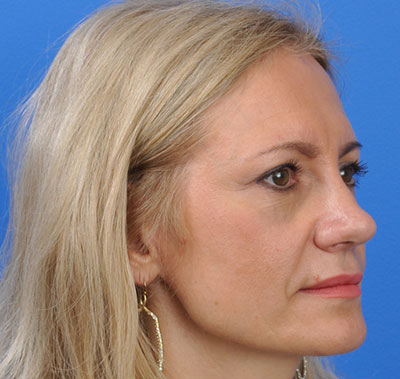 Rhinoplasty