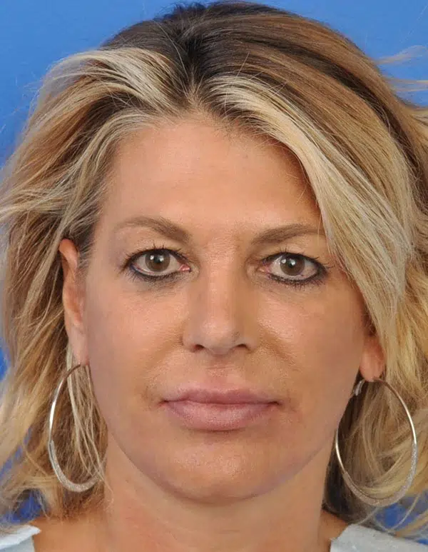 Facelift