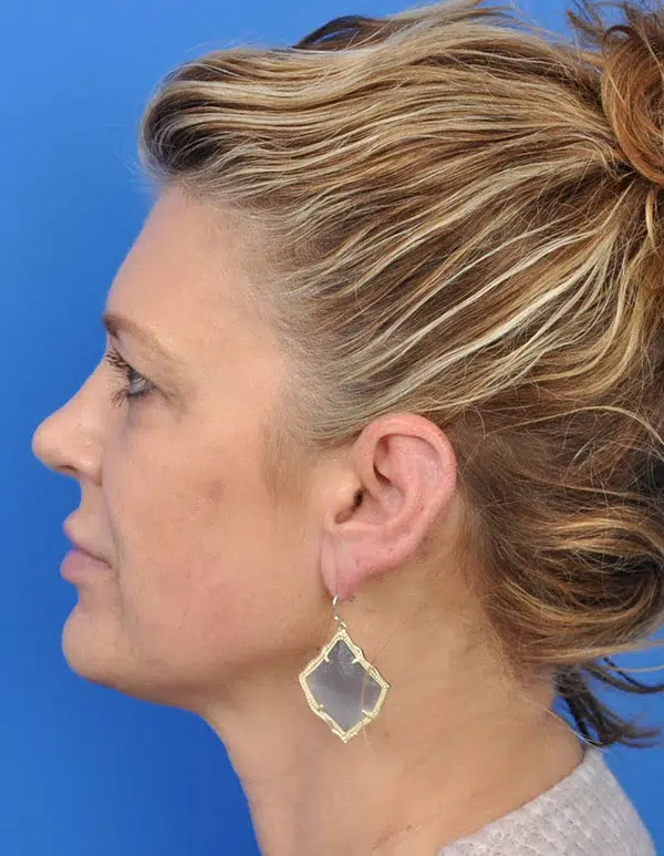 Facelift