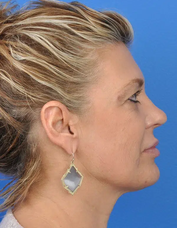 Facelift