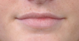 Juvederm® Before and After