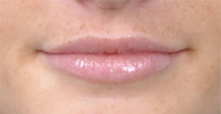 Lip Augmentation