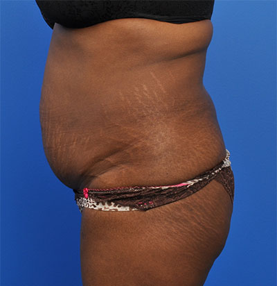 Abdominoplasty