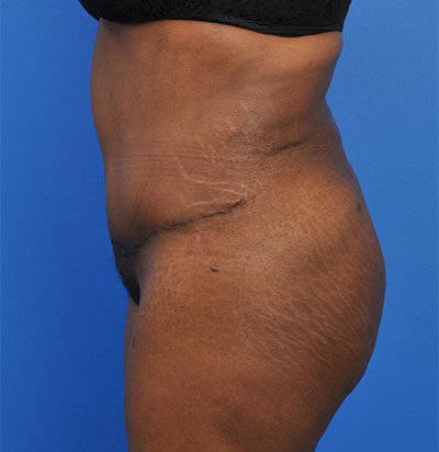 Abdominoplasty