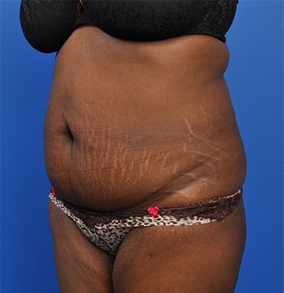 Abdominoplasty