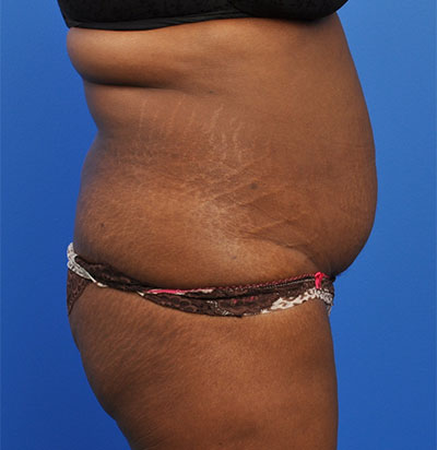 Abdominoplasty