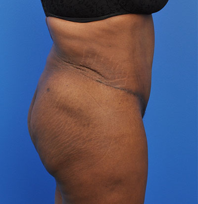 Abdominoplasty