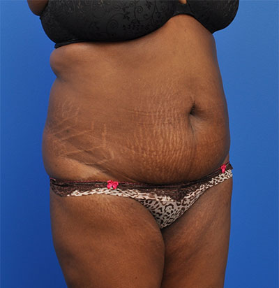 Abdominoplasty