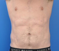 Male Liposuction