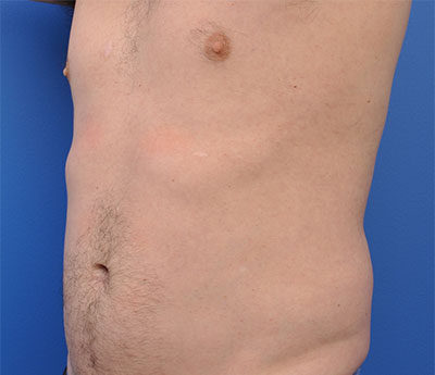 Male Liposuction