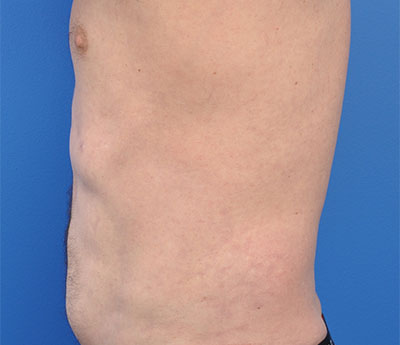 Male Liposuction