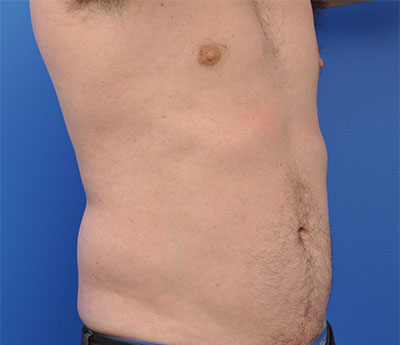 Male Liposuction