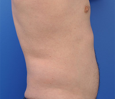 Male Liposuction