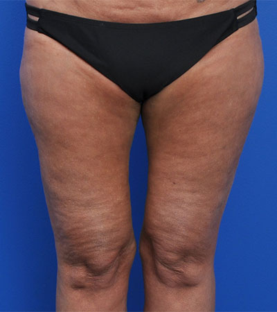 Thighplasty Results Chicago