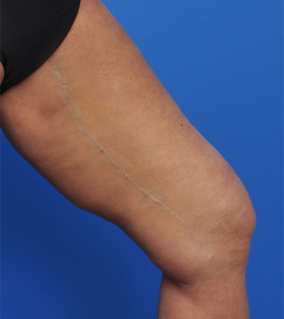 Thighplasty