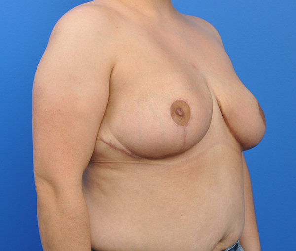 Breast Reduction