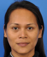 Facial Feminization Results Chicago