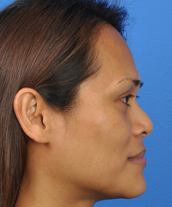 Rhinoplasty