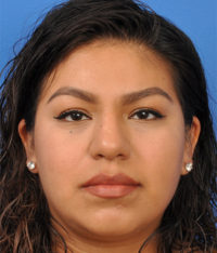 Rhinoplasty