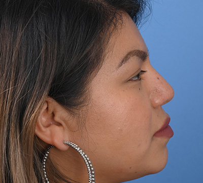 Rhinoplasty