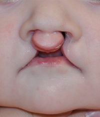 Cleft Lip