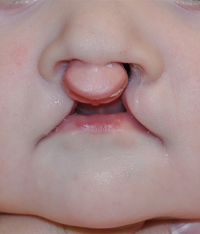 Cleft Lip