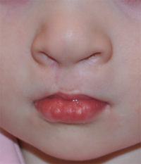 Cleft Lip